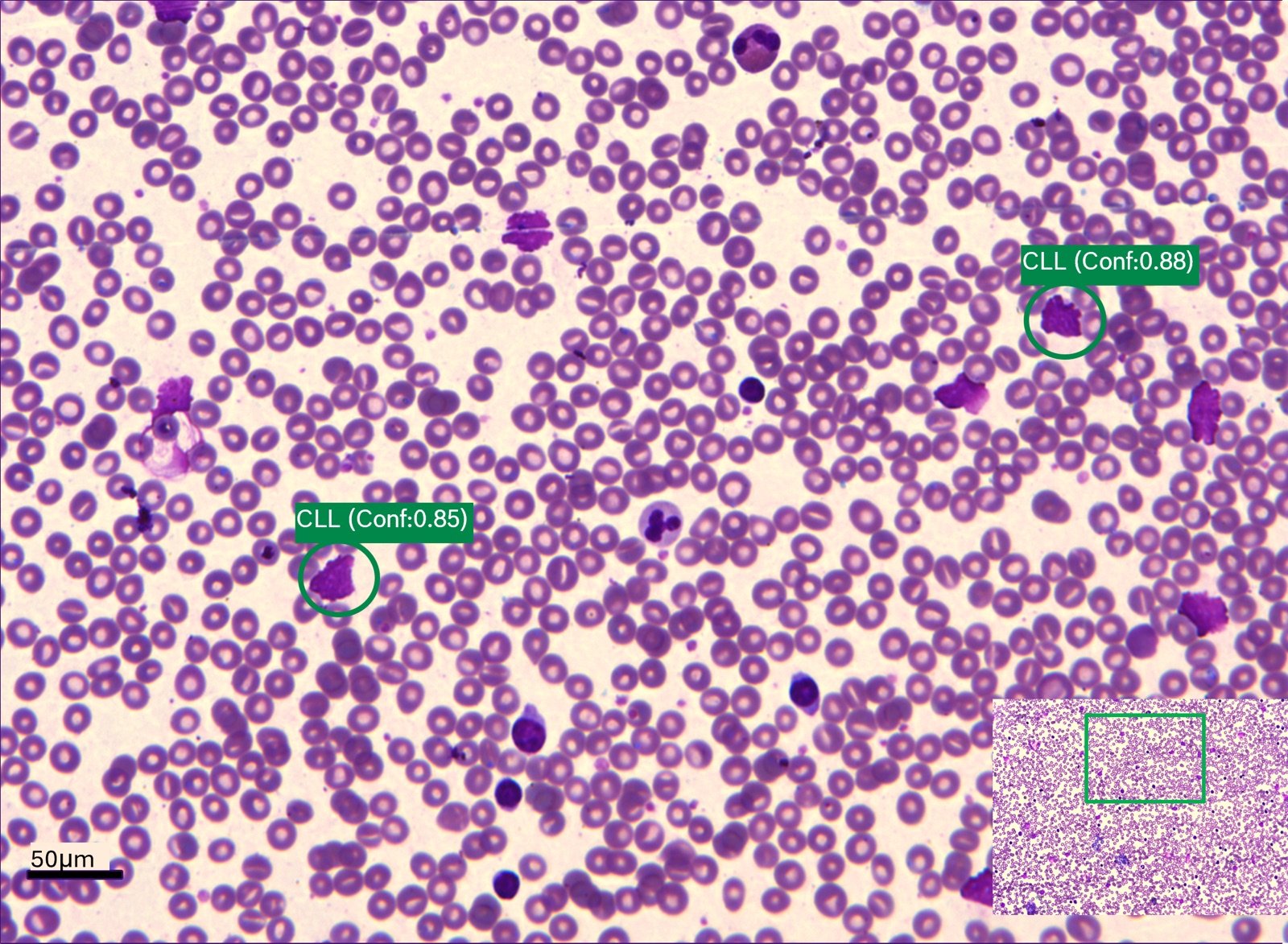 A blood smear under the microscope with AI-flagged cells of interest